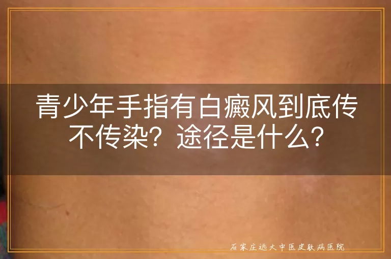 青少年手指有白癜风到底传不传染？途径是什么？