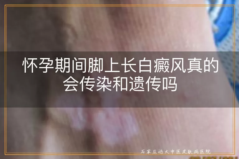 怀孕期间脚上长白癜风真的会传染和遗传吗