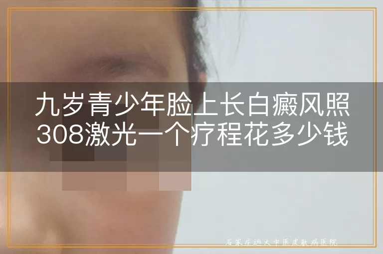 九岁青少年脸上长白癜风照308激光一个疗程花多少钱