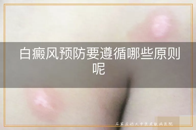 白癜风预防要遵循哪些原则呢