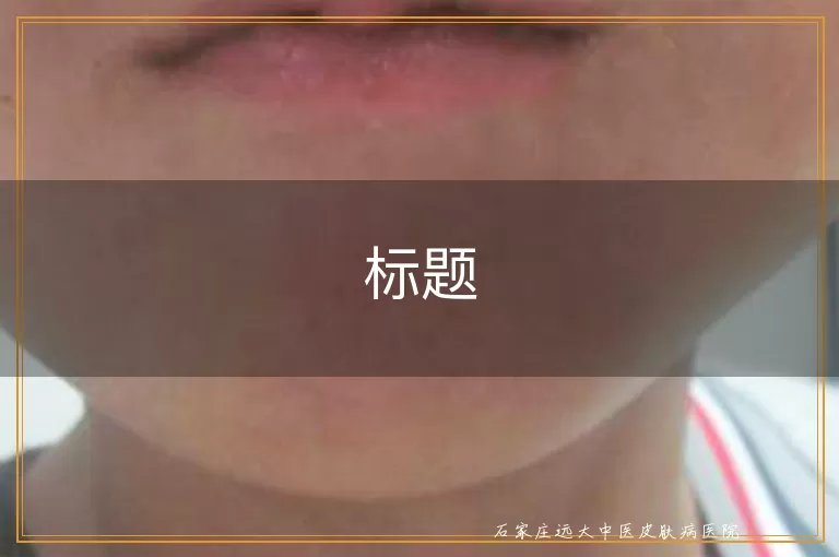 45岁头部长白癜风照308nm激光一个光斑多少钱？