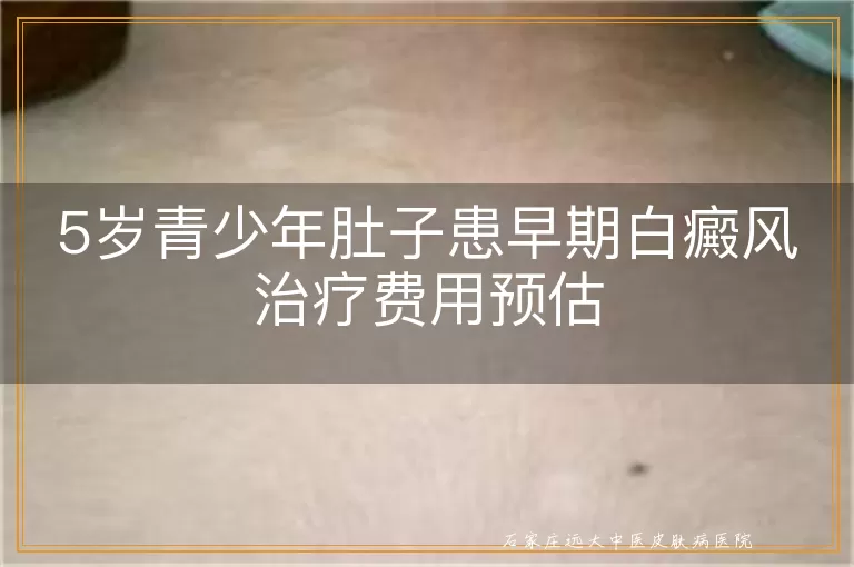 5岁青少年肚子患早期白癜风治疗费用预估