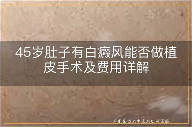 45岁肚子有白癜风能否做植皮手术及费用详解