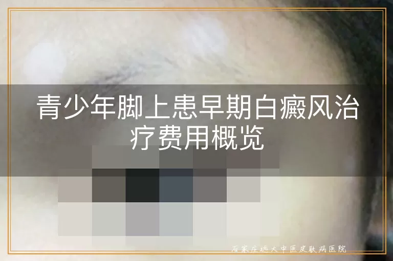青少年脚上患早期白癜风治疗费用概览
