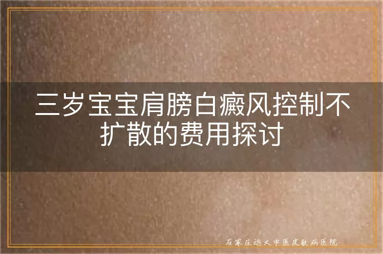 三岁宝宝肩膀白癜风控制不扩散的费用探讨