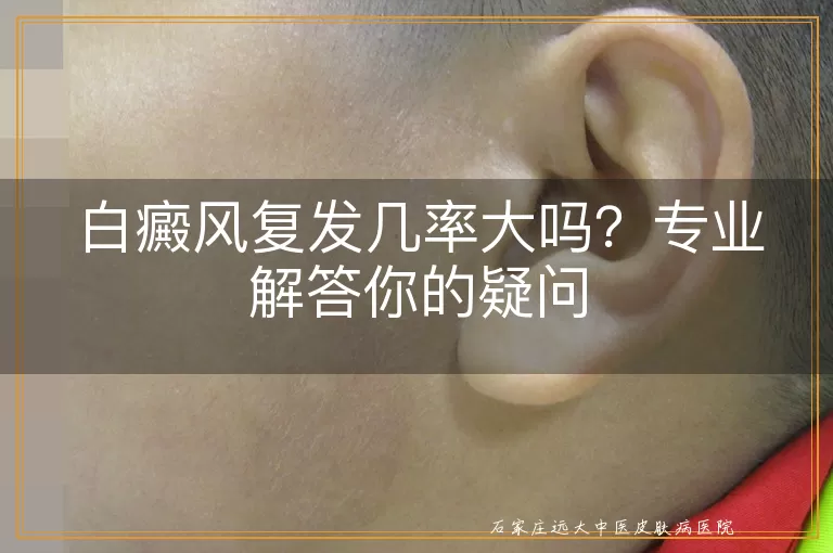 白癜风复发几率大吗?专业解答你的疑问
