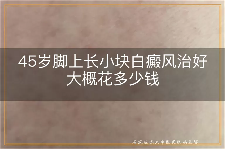 45岁脚上长小块白癜风治好大概花多少钱