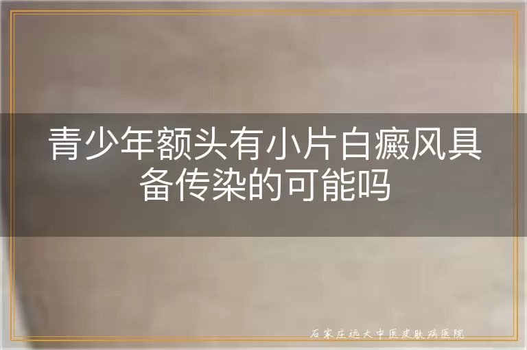 青少年额头有小片白癜风具备传染的可能吗