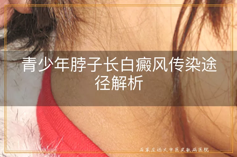 青少年脖子长白癜风传染途径解析