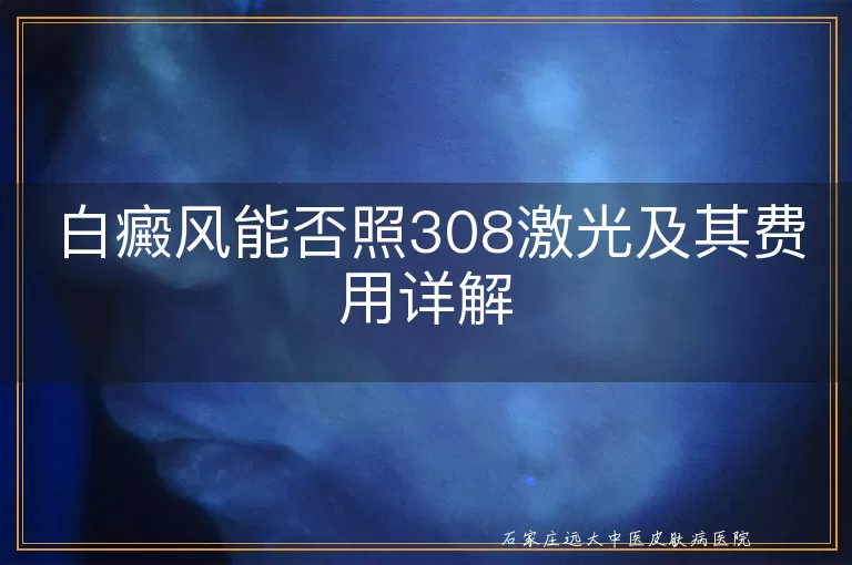 白癜风能否照308激光及其费用详解