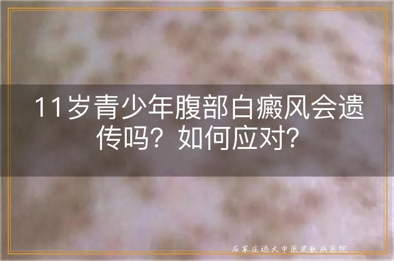 11岁青少年腹部白癜风会遗传吗？如何应对？