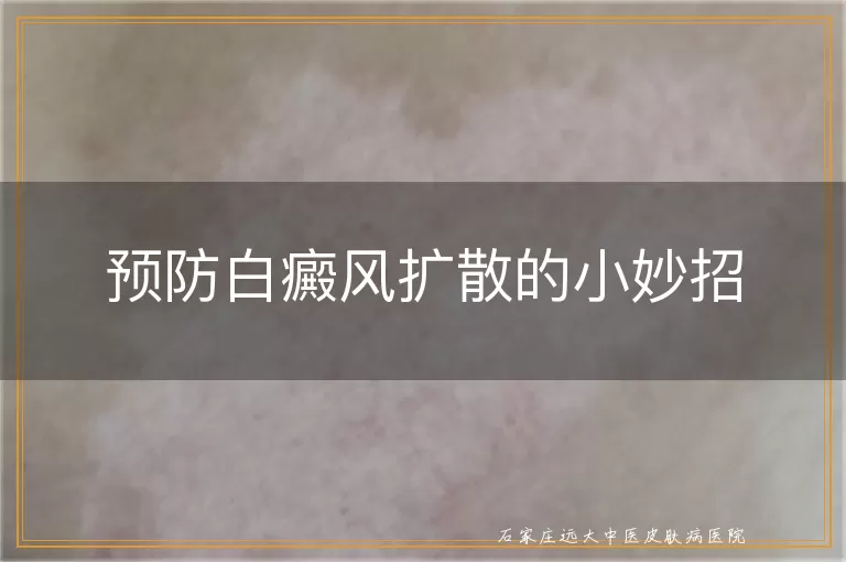 预防白癜风扩散的小妙招