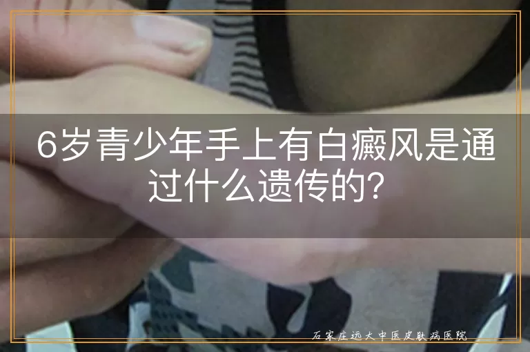 6岁青少年手上有白癜风是通过什么遗传的？