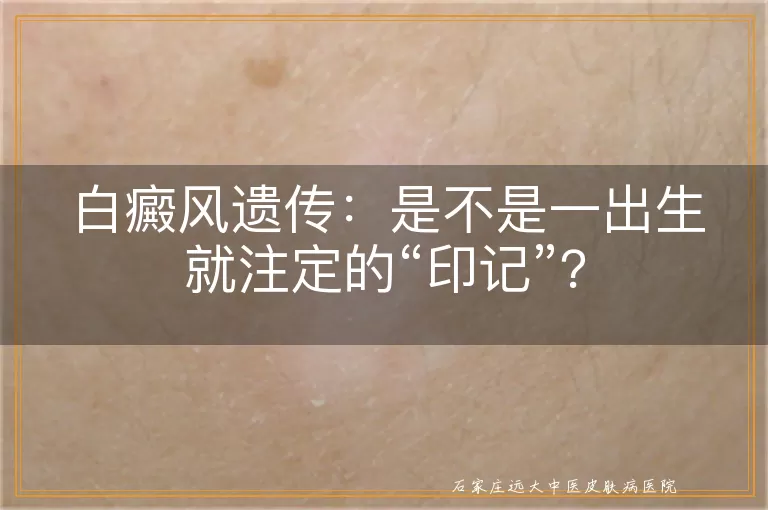 白癜风遗传：是不是一出生就注定的“印记”？