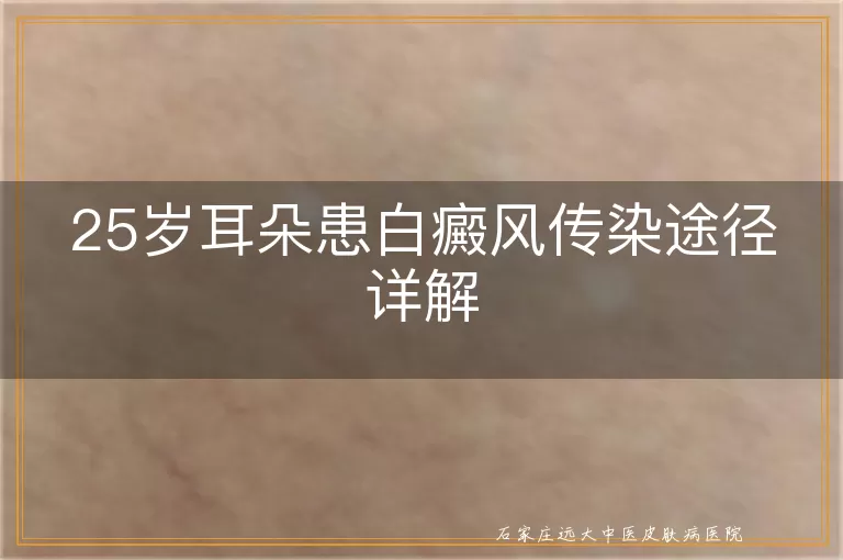 25岁耳朵患白癜风传染途径详解