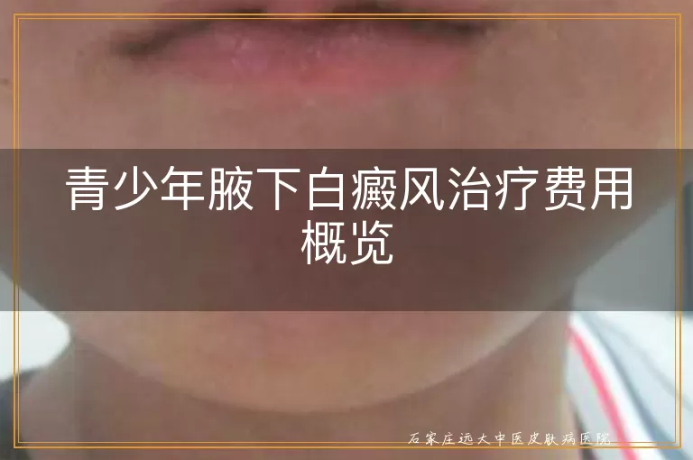 青少年腋下白癜风治疗费用概览