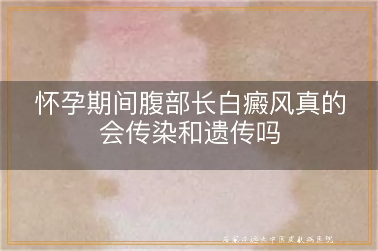 怀孕期间腹部长白癜风真的会传染和遗传吗