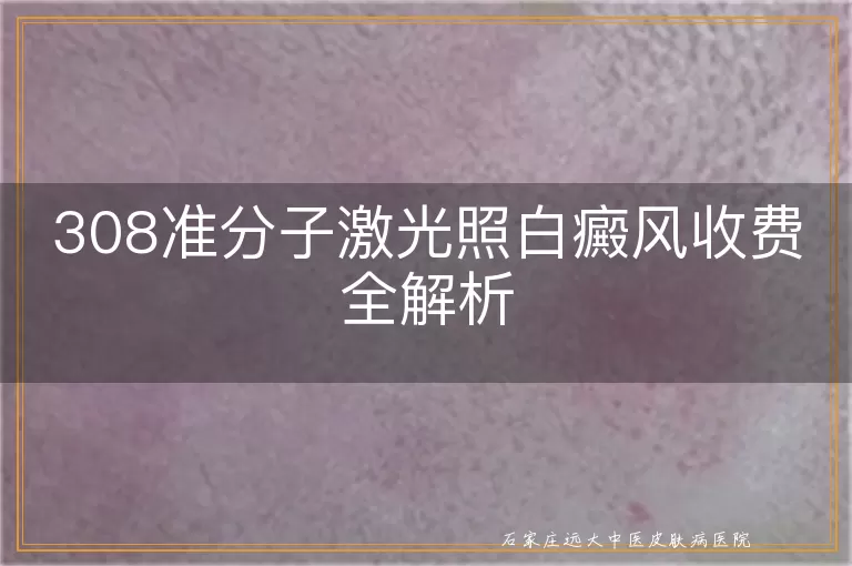 308准分子激光照白癜风收费全解析