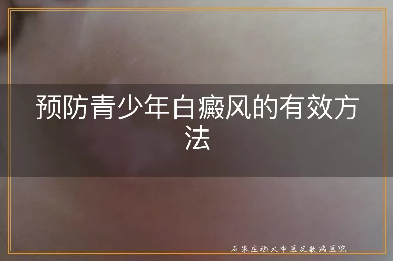 预防青少年白癜风的有效方法