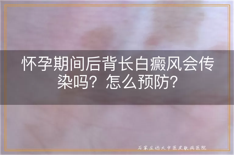 怀孕期间后背长白癜风会传染吗？怎么预防？
