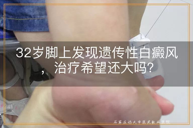 32岁脚上发现遗传性白癜风，治疗希望还大吗？
