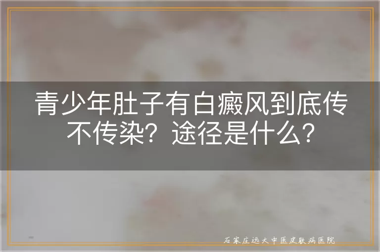 青少年肚子有白癜风到底传不传染?途径是什么?