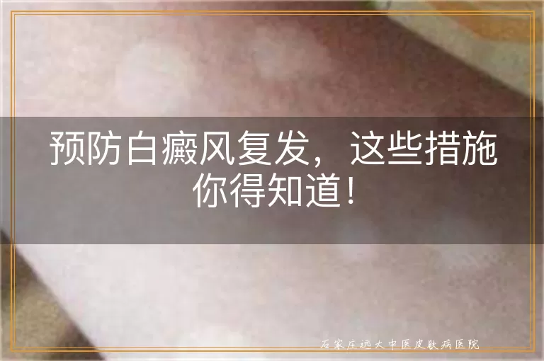 预防白癜风复发，这些措施你得知道！