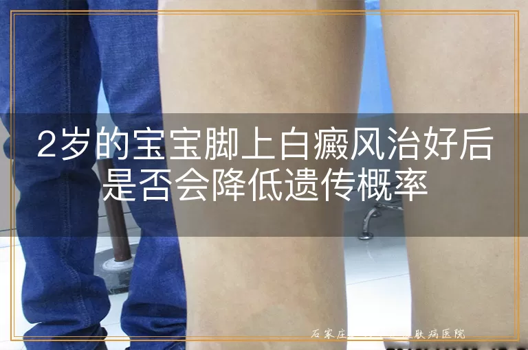 2岁的宝宝脚上白癜风治好后是否会降低遗传概率