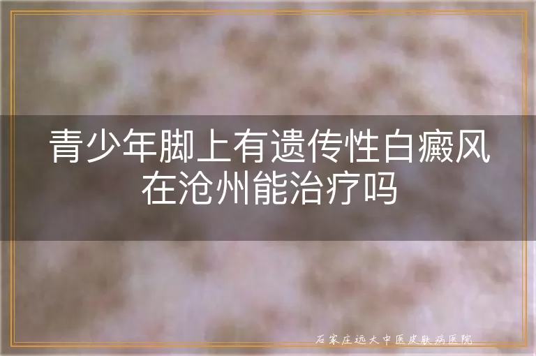 青少年脚上有遗传性白癜风在沧州能治疗吗