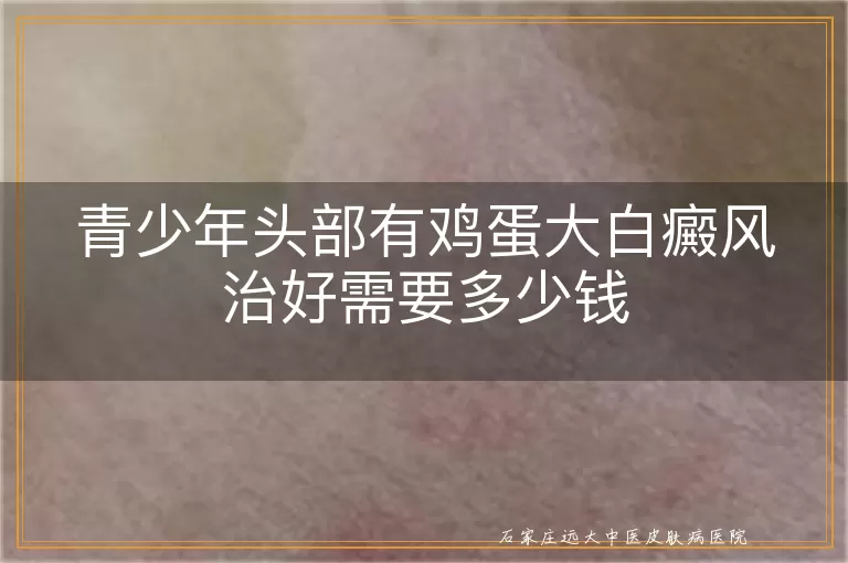 青少年头部有鸡蛋大白癜风治好需要多少钱