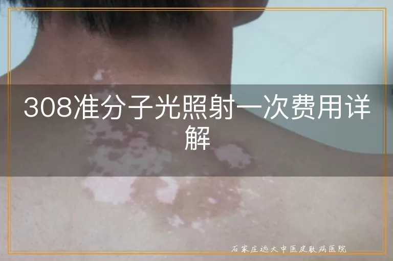 308准分子光照射一次费用详解