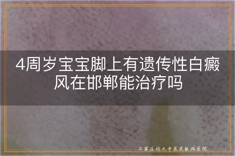 4周岁宝宝脚上有遗传性白癜风在邯郸能治疗吗