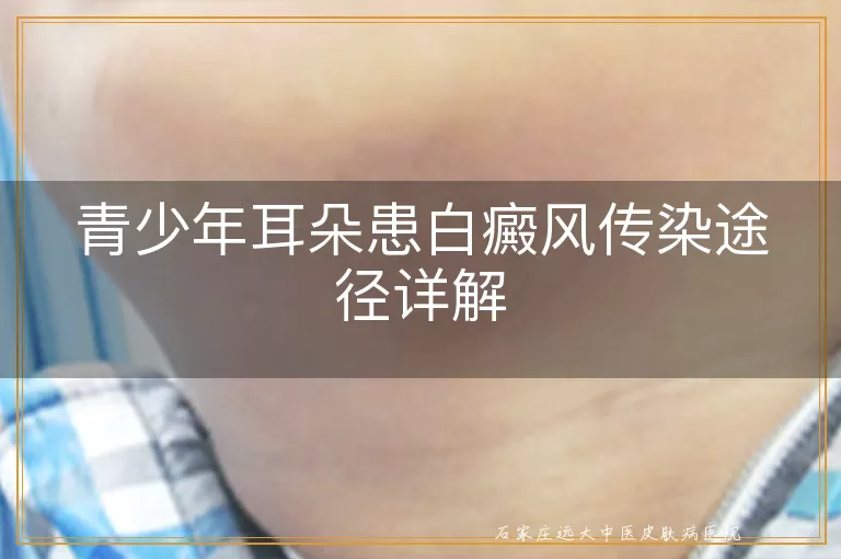 青少年耳朵患白癜风传染途径详解