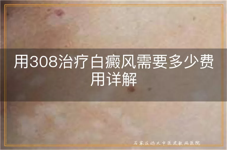 用308治疗白癜风需要多少费用详解