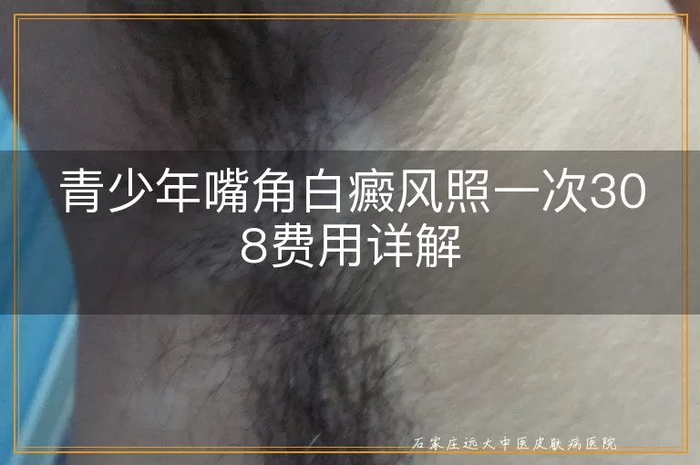 青少年嘴角白癜风照一次308费用详解