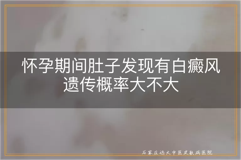 怀孕期间肚子发现有白癜风遗传概率大不大