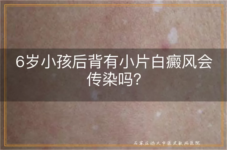 6岁小孩后背有小片白癜风会传染吗？