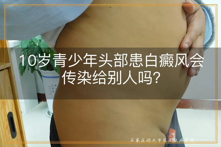 10岁青少年头部患白癜风会传染给别人吗？
