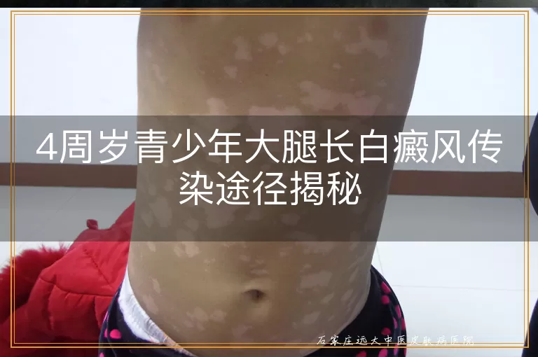 4周岁青少年大腿长白癜风传染途径揭秘