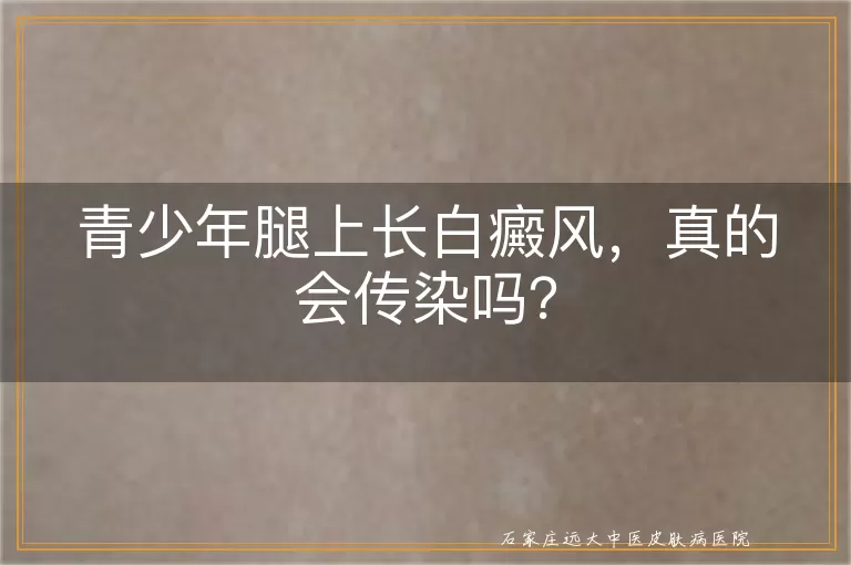 青少年腿上长白癜风，真的会传染吗？