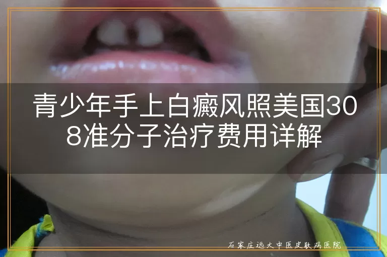 青少年手上白癜风照美国308准分子治疗费用详解