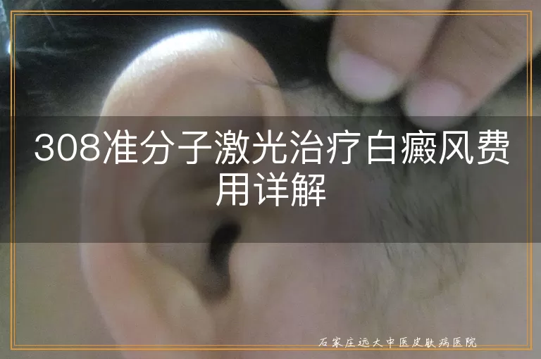 308准分子激光治疗白癜风费用详解