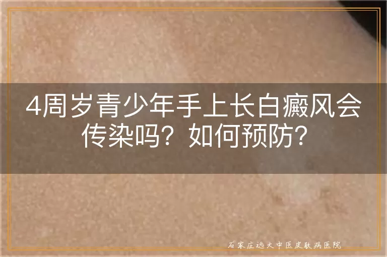 4周岁青少年手上长白癜风会传染吗？如何预防？