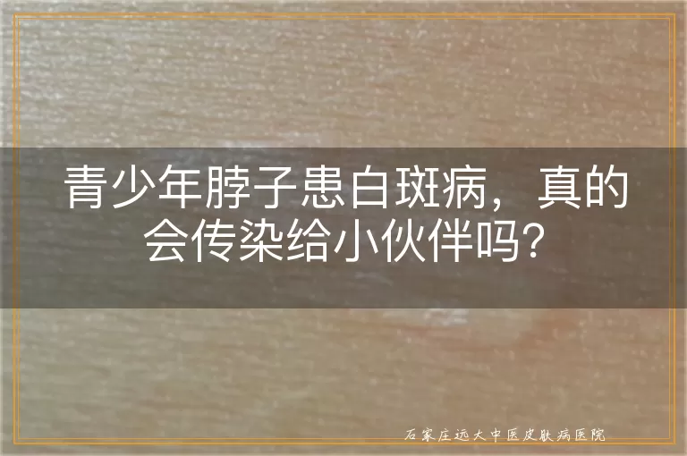 青少年脖子患白斑病，真的会传染给小伙伴吗？