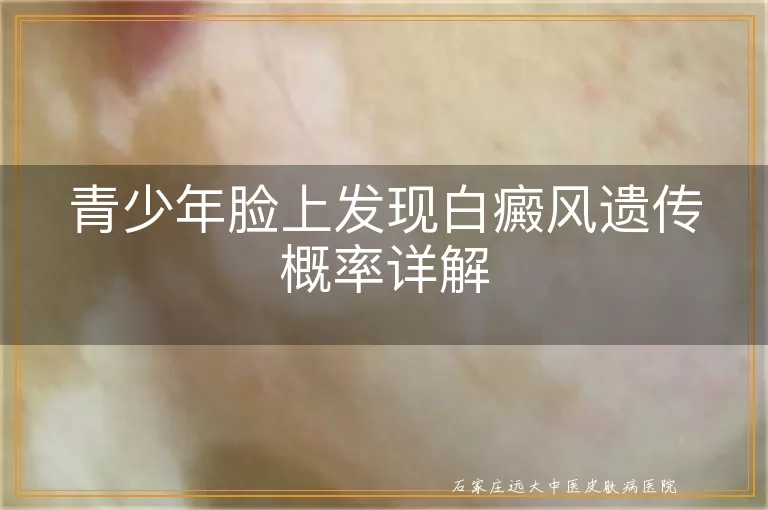 青少年脸上发现白癜风遗传概率详解