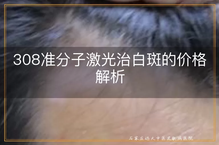 308准分子激光治白斑的价格解析