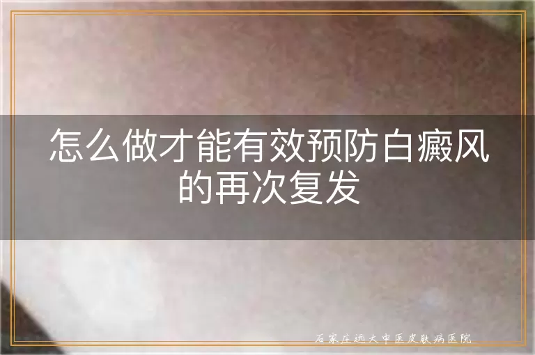 怎么做才能有效预防白癜风的再次复发