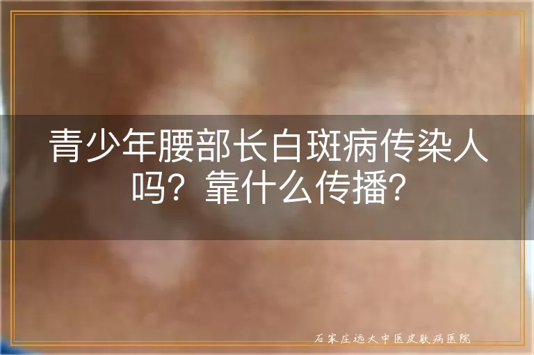 青少年腰部长白斑病传染人吗？靠什么传播？