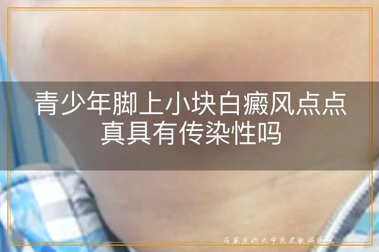 青少年脚上小块白癜风点点真具有传染性吗