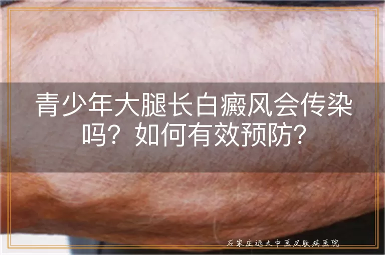 青少年大腿长白癜风会传染吗？如何有效预防？